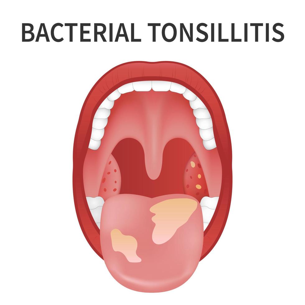 Bacterial and viral tonsillitis. Angina, pharyngitis, and tonsillitis. Tonsil infection. Open Mouth. vector