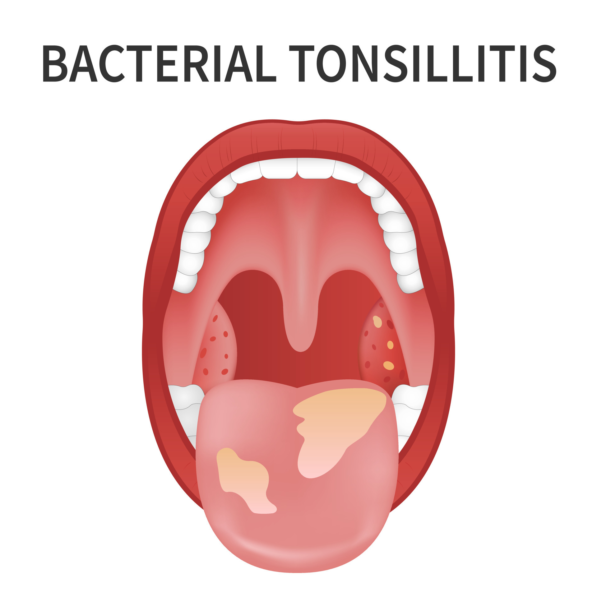 Tonsillitis Bacterial Viral Angina Pharyngitis Tonsillitis Stock Vector ...