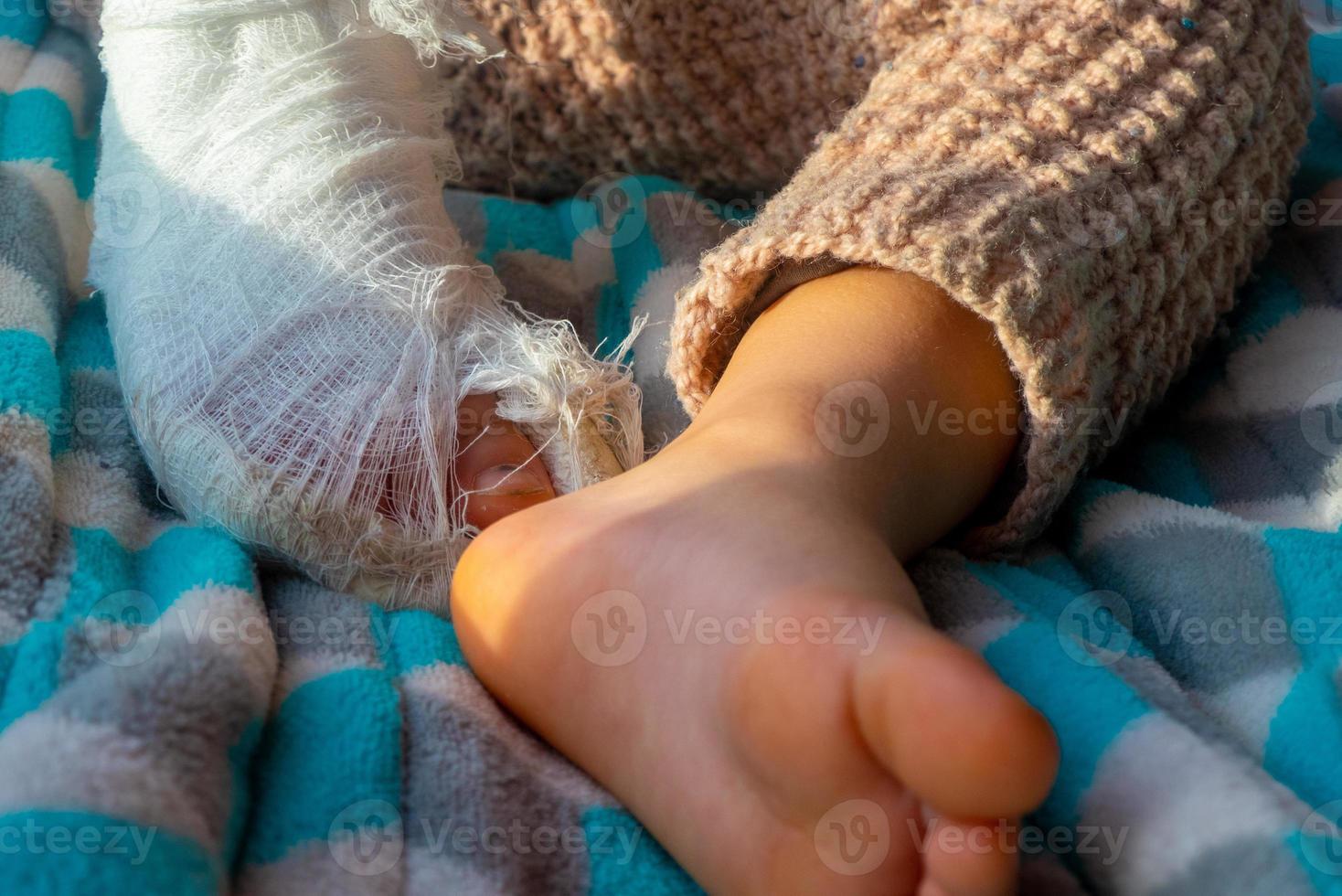 Child with bandage on leg heel fracture. Broken right foot, splint of toddler. Little boy sleeping on a blue blanket. photo