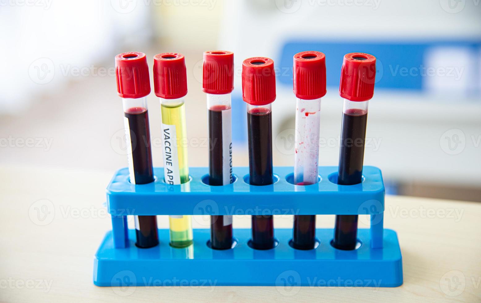 COVID-19, Corona Virus vaccine and positive patient infection sample blood testing in laboratory for diagnosis new Corona virus infection in the hospital photo