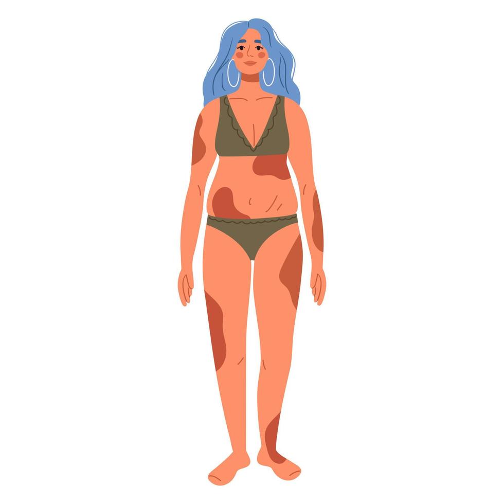 Woman with melasma, dark brown pigment spots on body. Dermatology, cosmetology concept. Skin cancer concept. Inclusion and body-positivity concept. Flat Vector Illustration