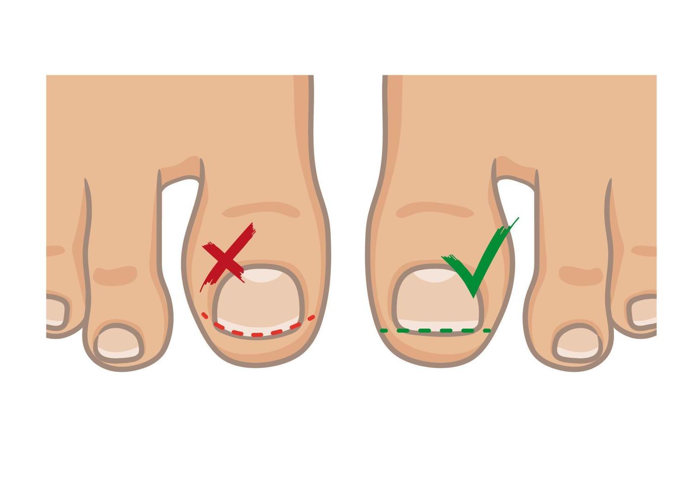 How to cut toenails, right and wrong concept. How to avoide ingrown nail. Female or male foot sole, barefoot, top view. Vector illustration, hand drawn cartoon style isolated on white.