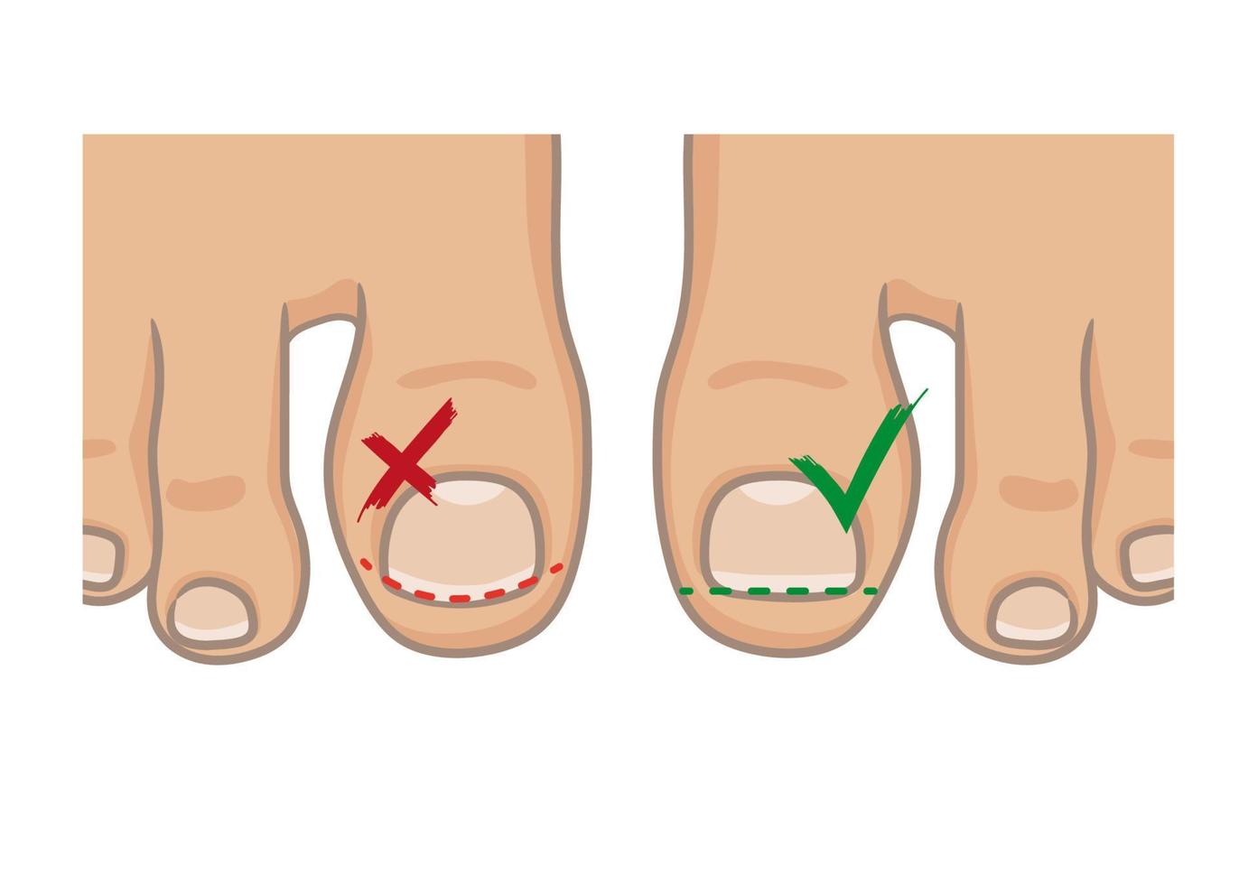 cómo cortar las uñas de los pies, el concepto correcto e incorrecto. como evitar una uña encarnada. planta del pie femenino o masculino, descalzo, vista superior. ilustración vectorial, estilo de dibujos animados dibujados a mano aislado en blanco. vector