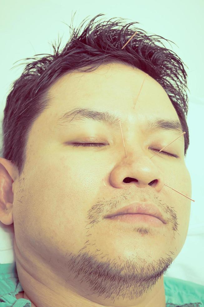 Vintage style photo of asian man is receiving Acupuncture treatment