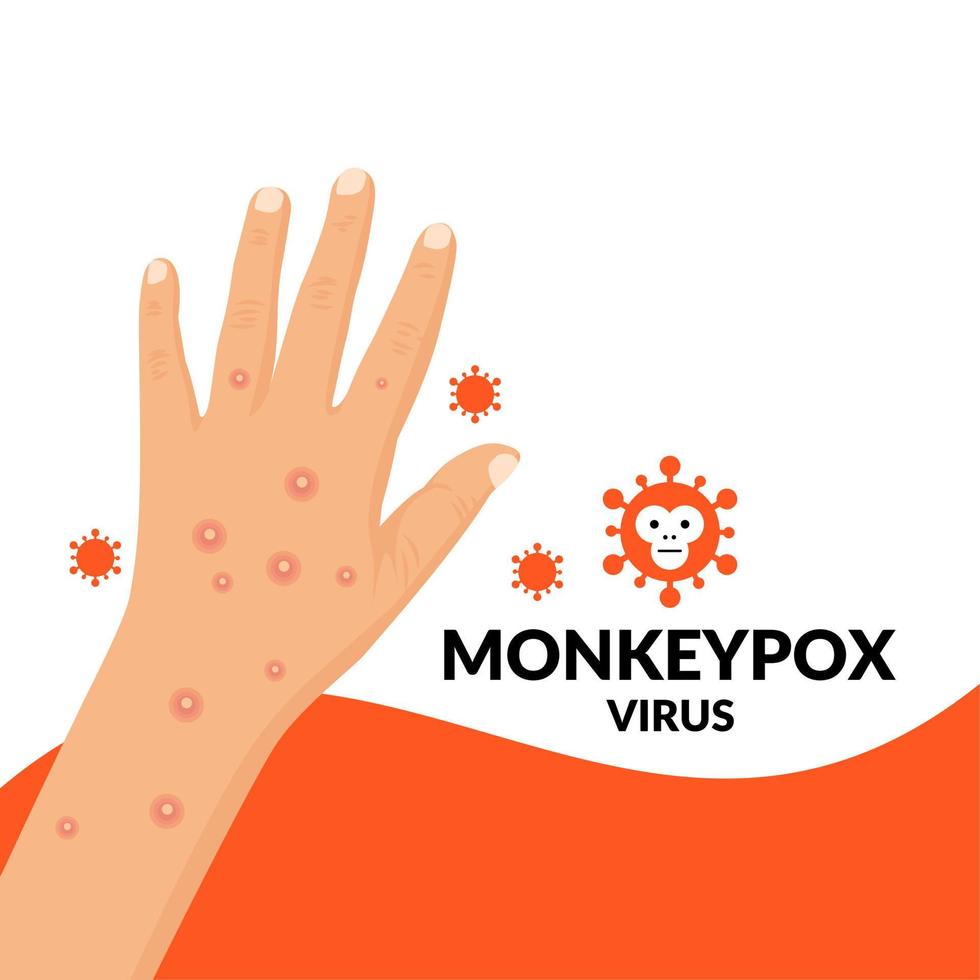 Vector illustration, hands exposed to monkeypox virus, as an educational poster or banner.