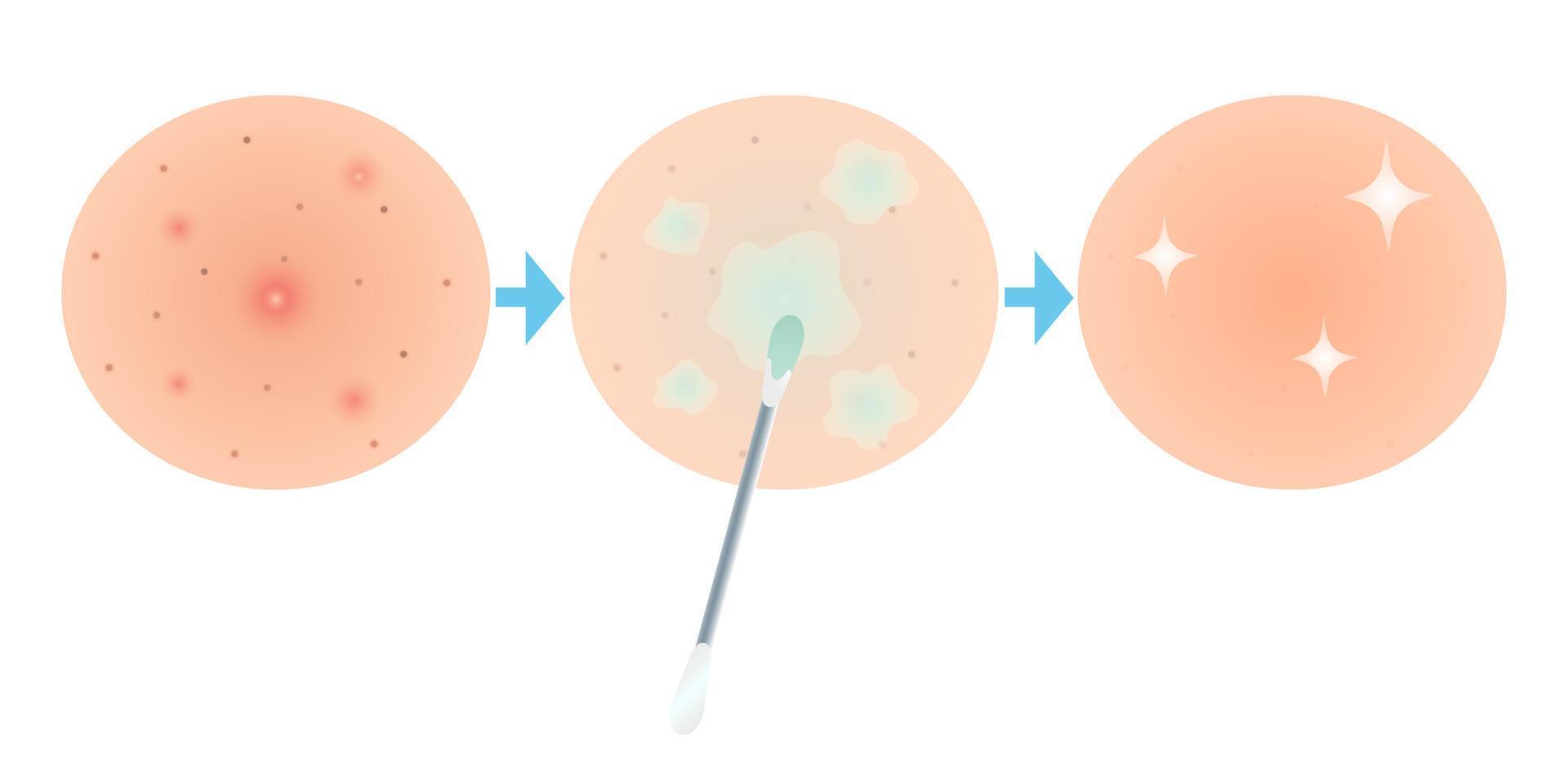 Acne treatment skin problems. Before after. Clean skin icons. Zoom. Flat Cartoon Line style. Vector illustration for beauty and medical design.