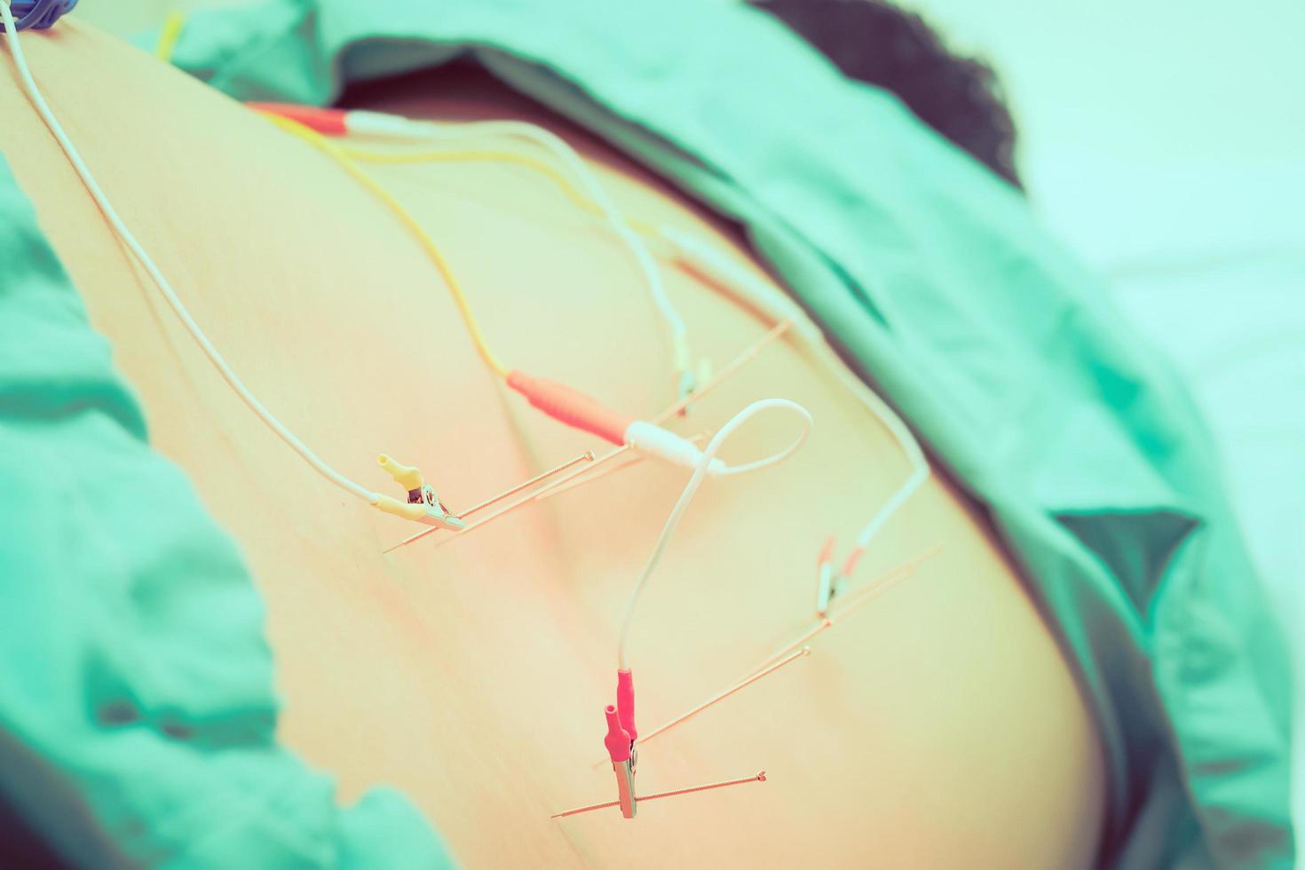 Vintage style photo of asian man is receiving acupuncture treatment. Closeup at needles at his back with electricity pulses call electroacupuncture.