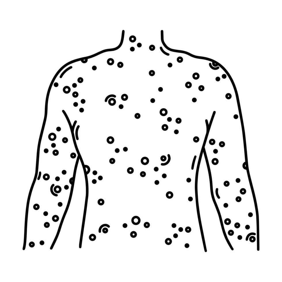 Painful rash on back vector icon. Human torso with sores, ulcers, blisters on the skin. Symptom of a viral, bacterial, allergic disease. Smallpox, dermatitis, eczema. Black outline isolated on white