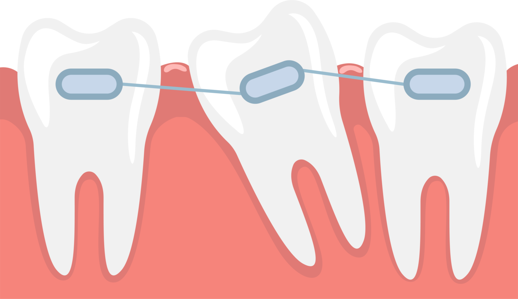 Braces clipart design illustration png