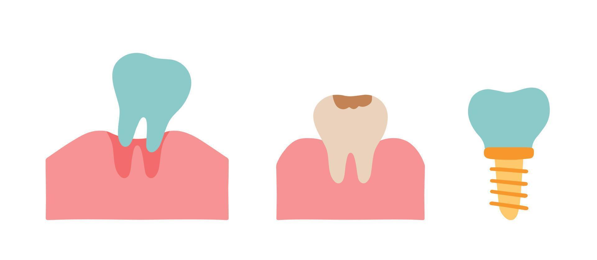 Dental implants surgery concept. Anatomical poster with human teeth. Tooth is removed by forceps in oral cavity. Cute cartoon of cavity tooth concept vector illustration. Dental treatment by dentist.