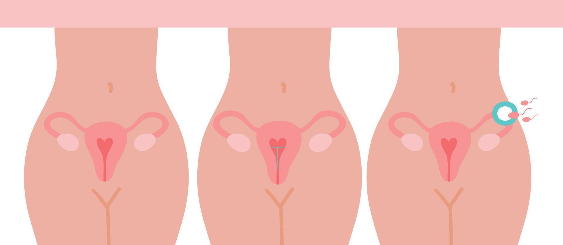 Fertilization icon. Uterus, sperm, insemination. Fertilization in the fallopian tube. The method of IUD contraception is not isolated. vector