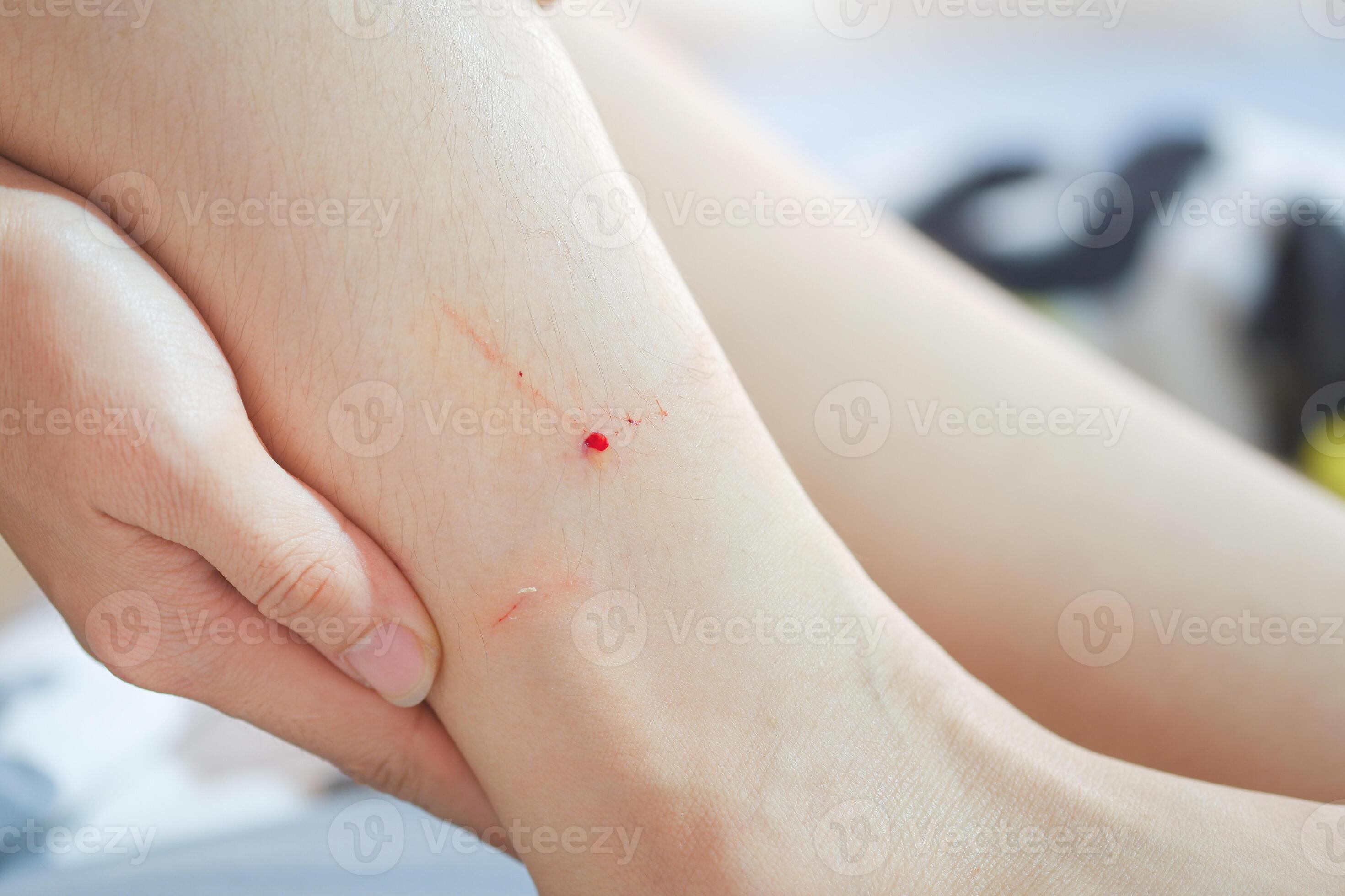 cat-bite