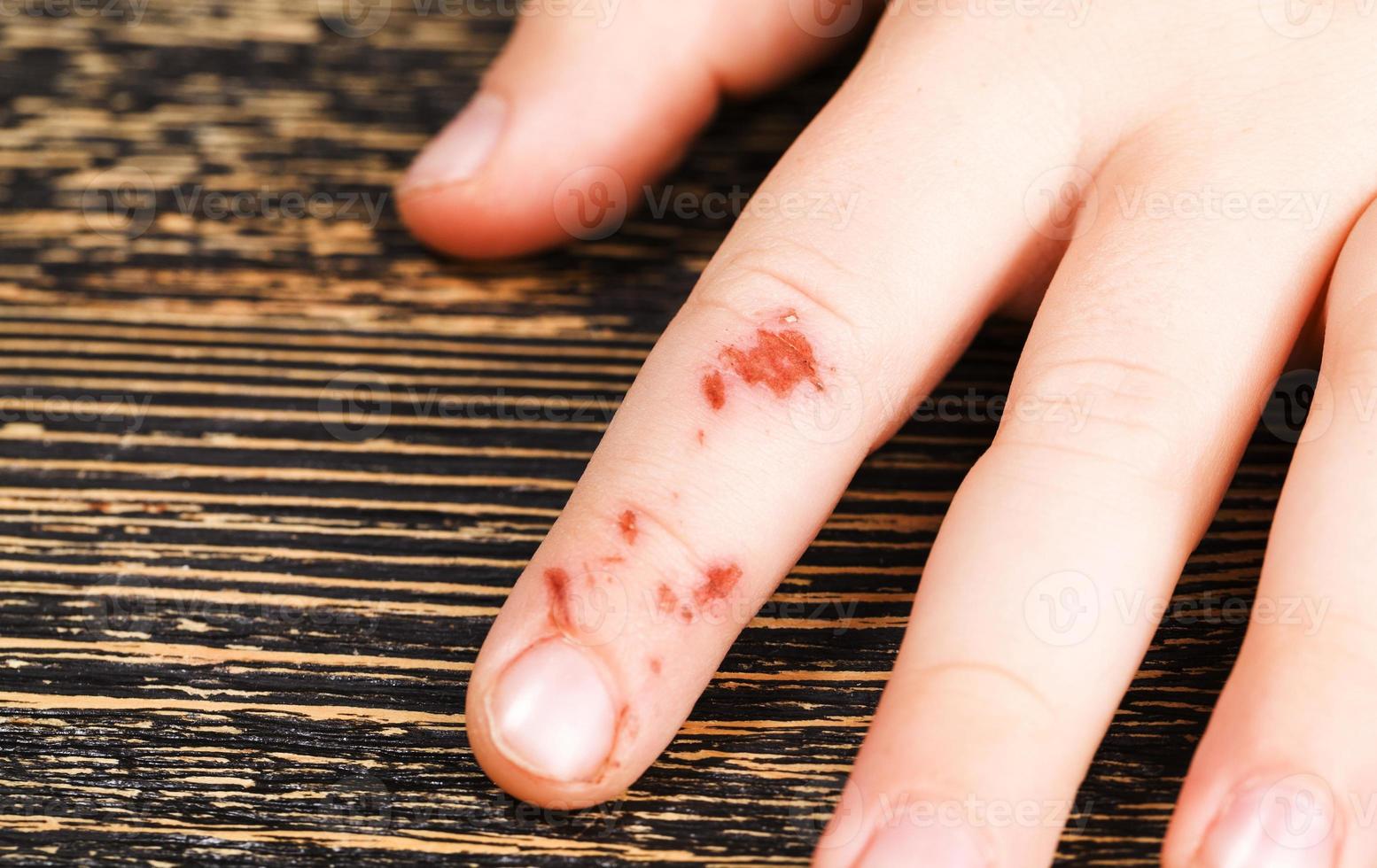 finger is already healing photo