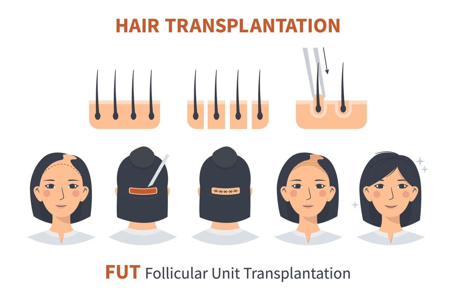 Stages of woman hair transplantation FUT Follicular Unit. Treatment surgery of baldness, alopecia, hair loss. Vector medical infographics, a female head scalp. Strip, graft machine.