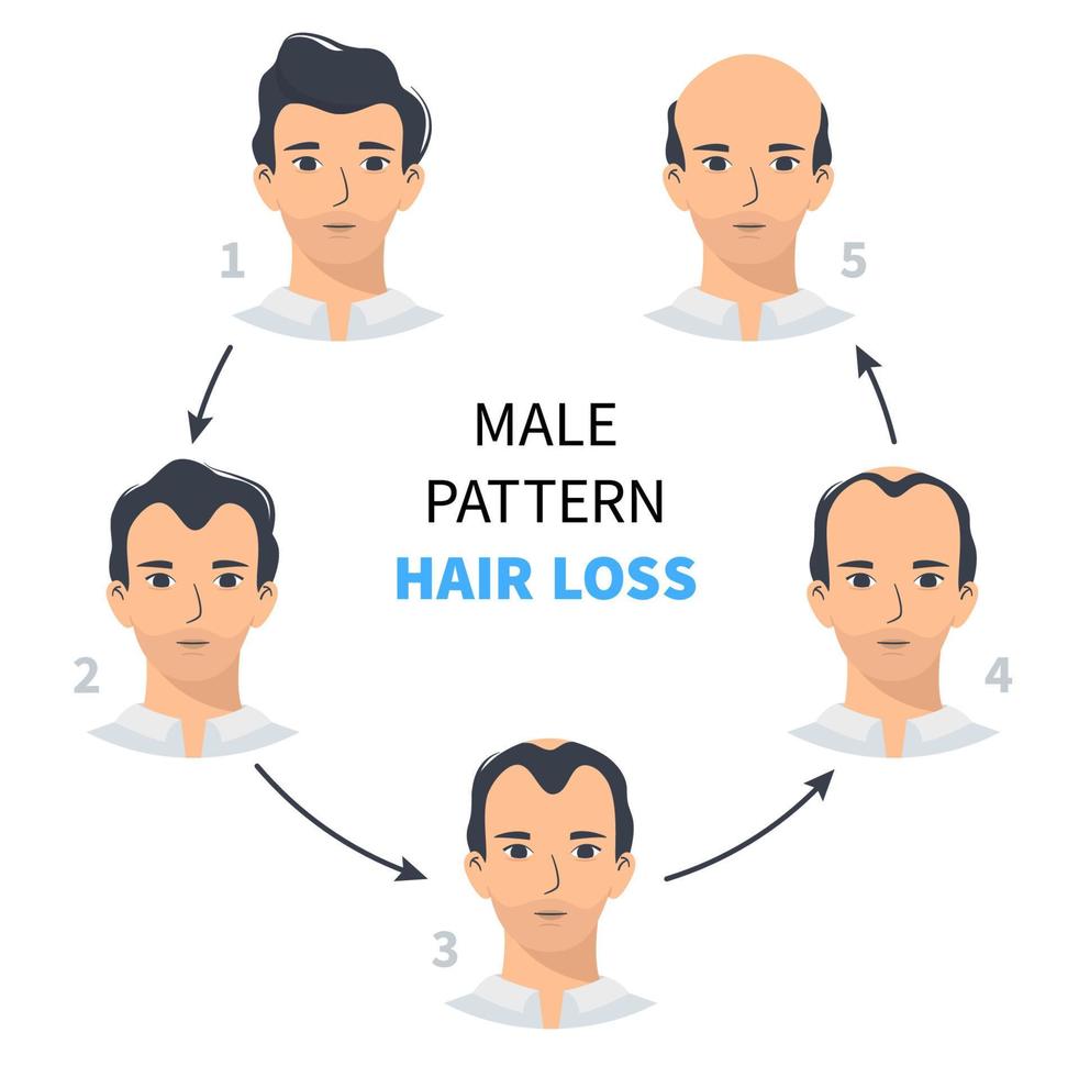 etapas de pérdida de cabello, patrón masculino de alopecia androgenética. pasos de infografía vectorial de calvicie en un estilo plano con un hombre. millas por hora vector