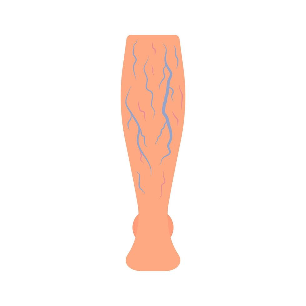 Leg with spider vascular and vein from pressure, disease varicose, thrombosis. Deep vein thrombosis DVT , abnormally of blood vascular flow. Blocked circulation in blood vessel. Vector illustration
