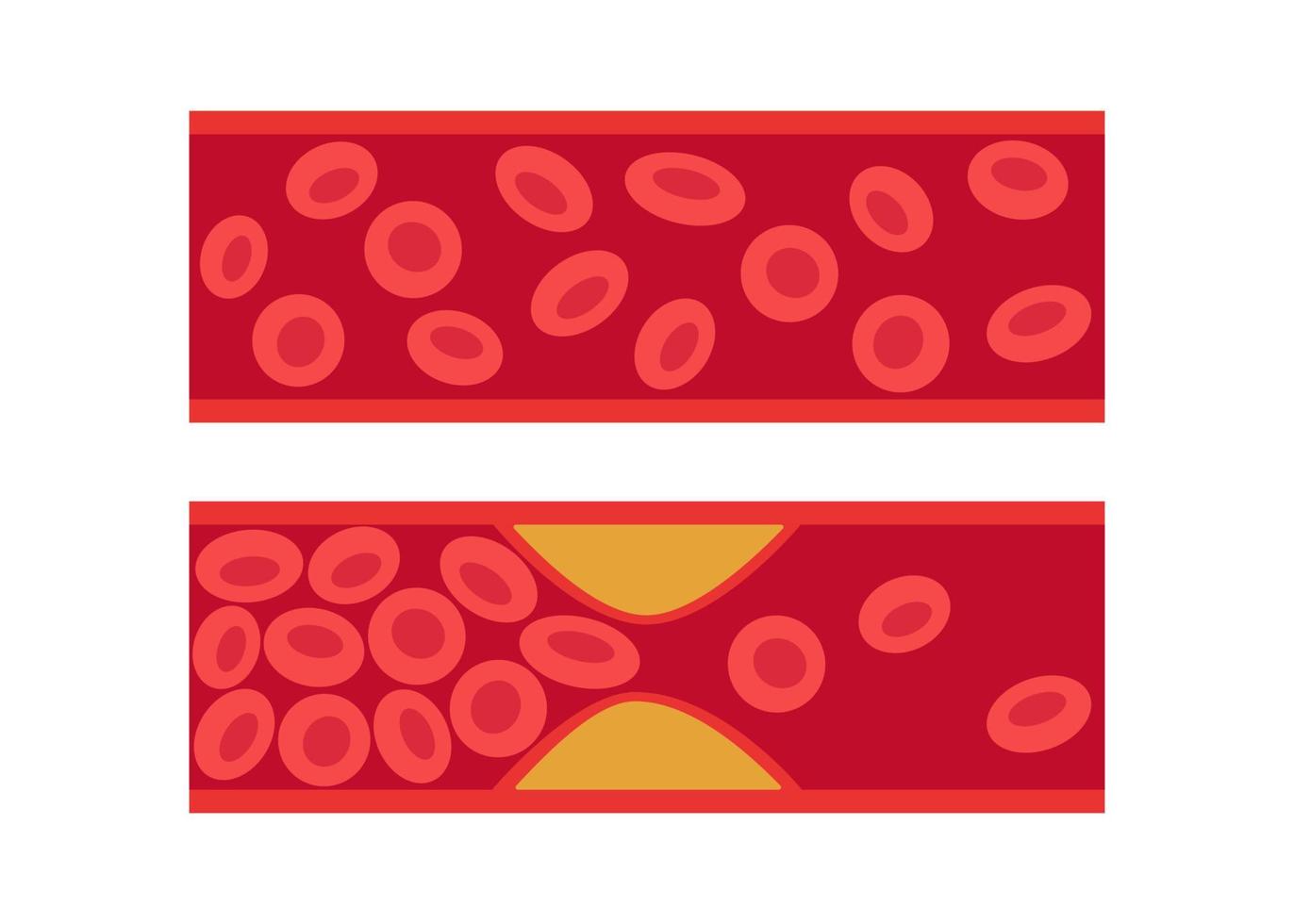 Normal and cholesterol-blocked artery. Blood clot, thrombus, atherosclerotic plaque. Deep vein thrombosis DVT or arterial clot, blood vascular flow. Blocked circulation in blood vessel. Vector