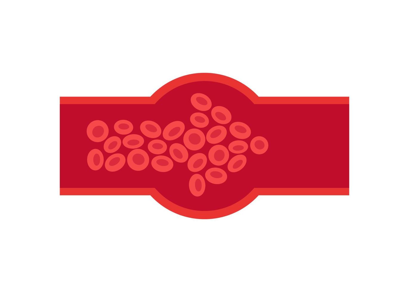 Deep vein thrombosis DVT , artery and vein disease, abnormally of blood vascular flow. World Thrombosis Day. Cholesterol blocked in human blood vessel. Vector illustration