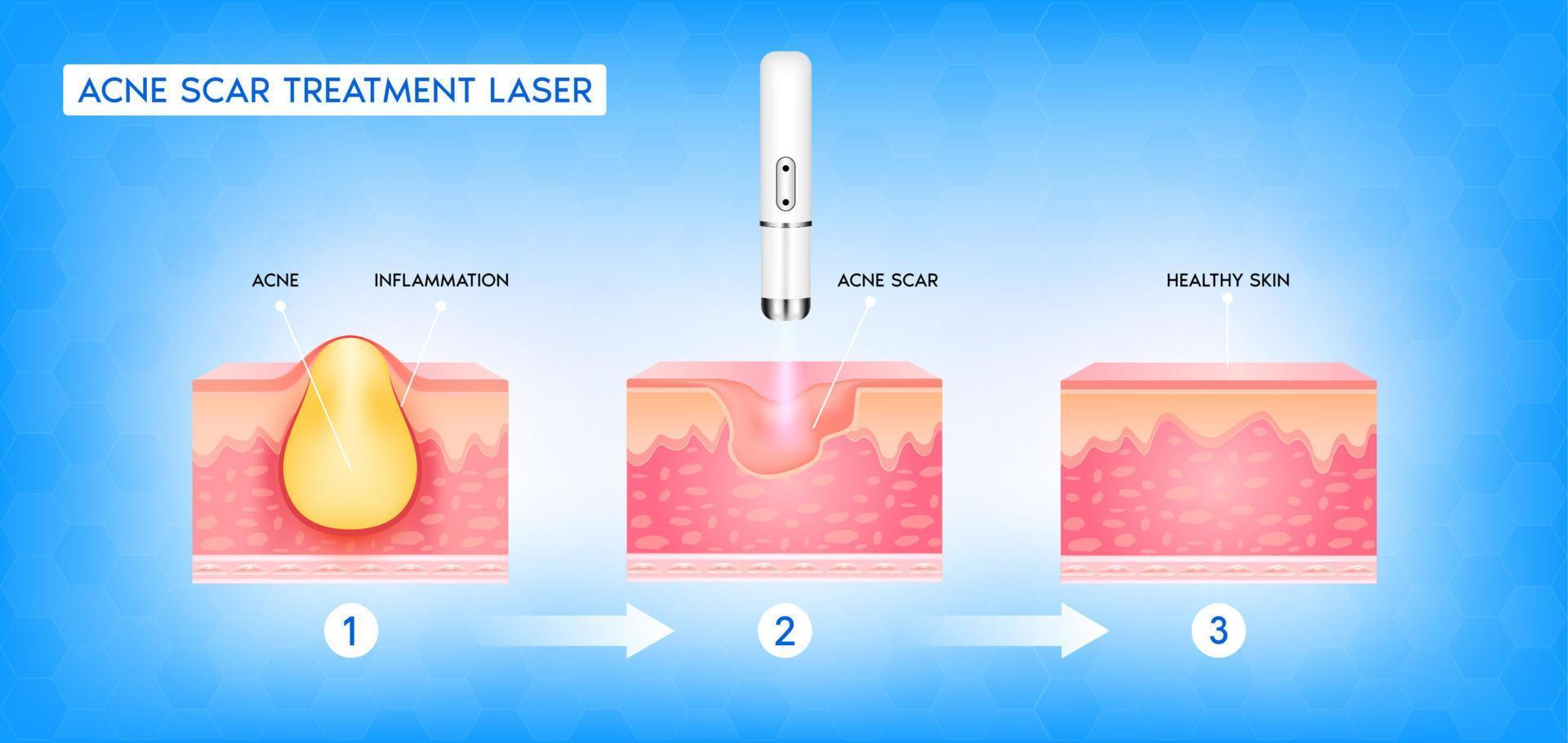 Acne scar vascular laser treatment. Inflammation associated with pimples. The structure of the skin acne scar. Medical beauty skin care concept. 3D vector illustration.