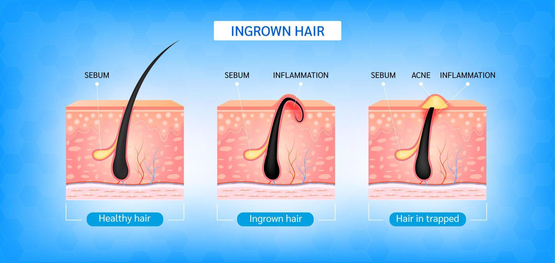 Ingrown hair. Hair has grown back into the skin surface after shaving. Formation of skin acne or pimple. Anatomy infographics of hair and skin. 3D vector illustration.
