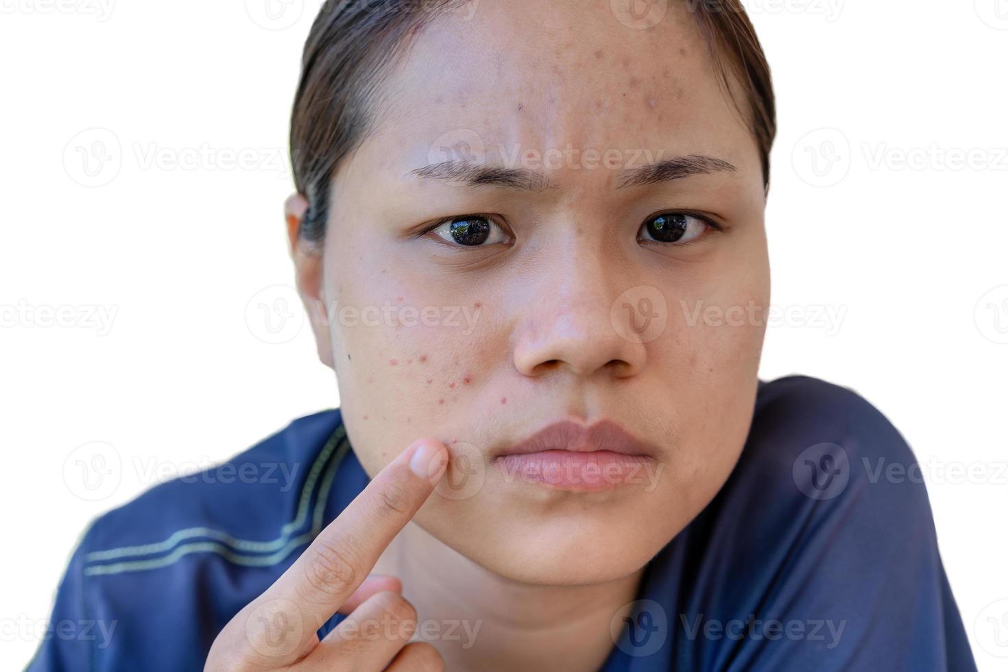 Young Asian woman worry about her face when she has problems with skin on her face. Problems with acne and scar on the female skin isolated on white background. Problem skincare and health concept. photo