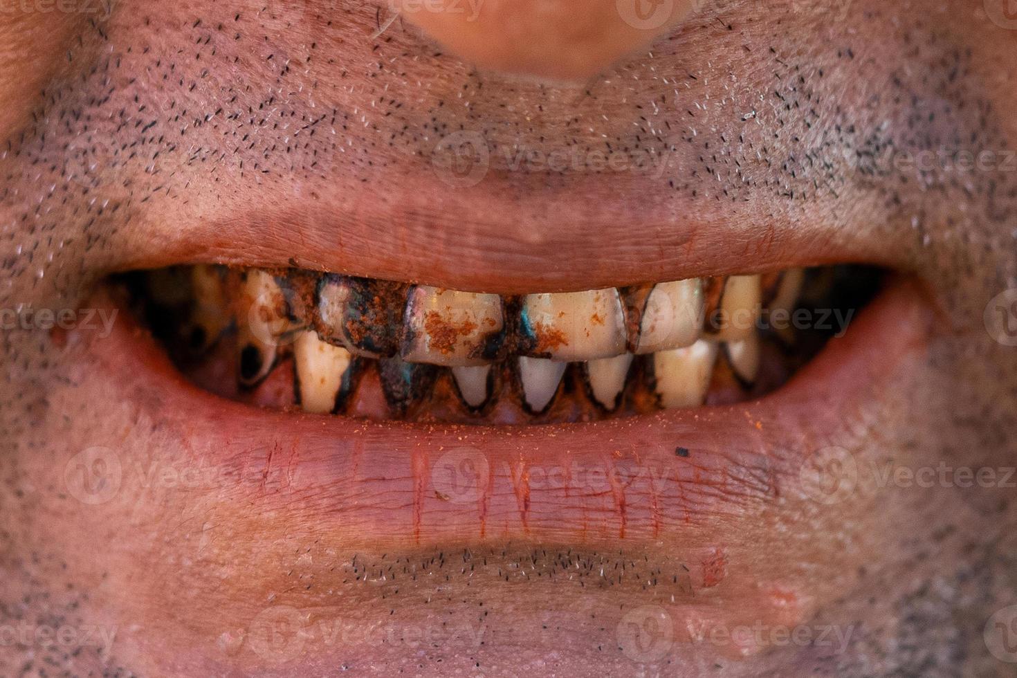 Plaque teeth cavities and paradontosis in the man's mouth. Dental decay problems and bad smile. Dentist treatment concept. photo