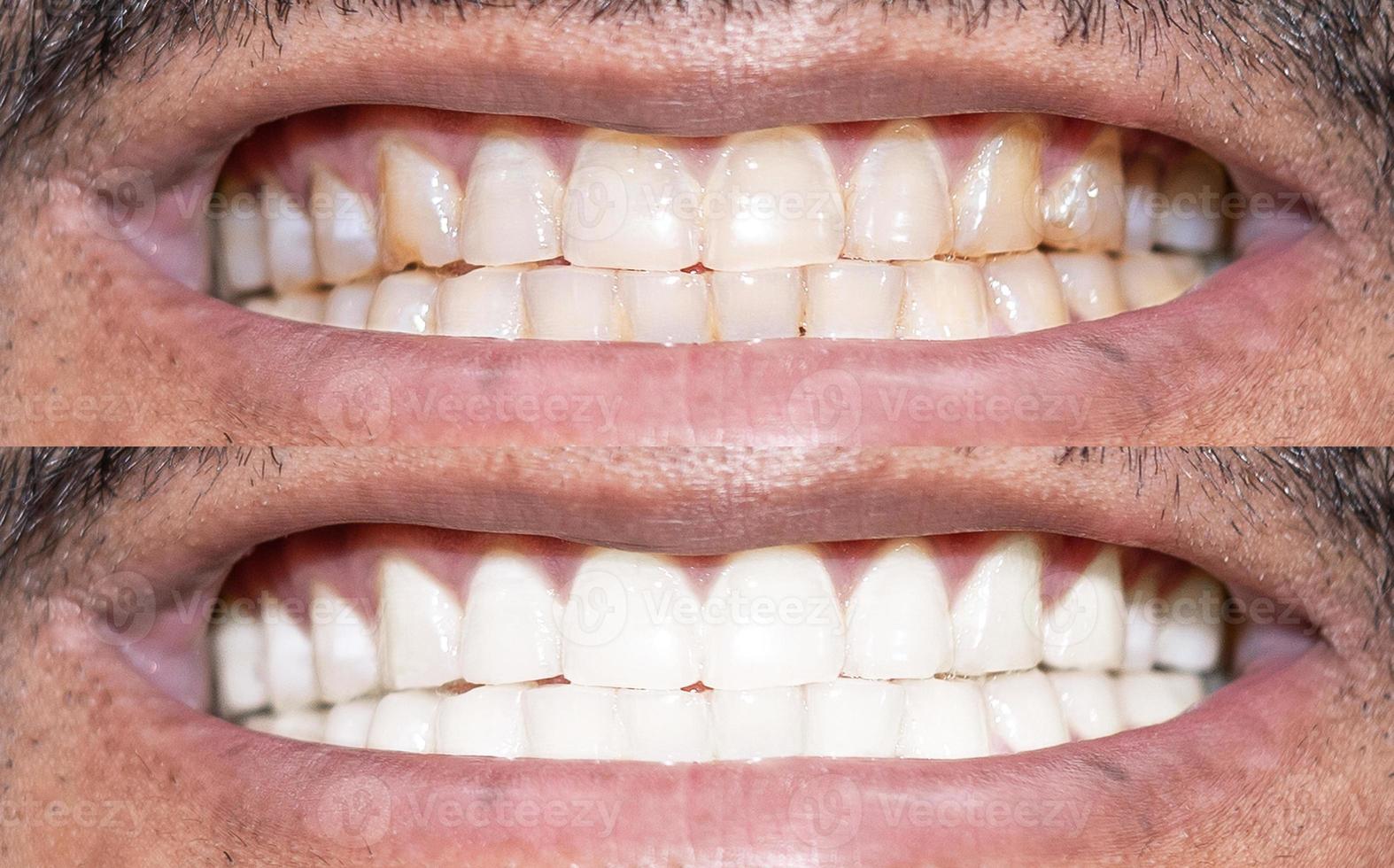 primer plano de los dientes humanos sonrientes antes y después del blanqueamiento foto