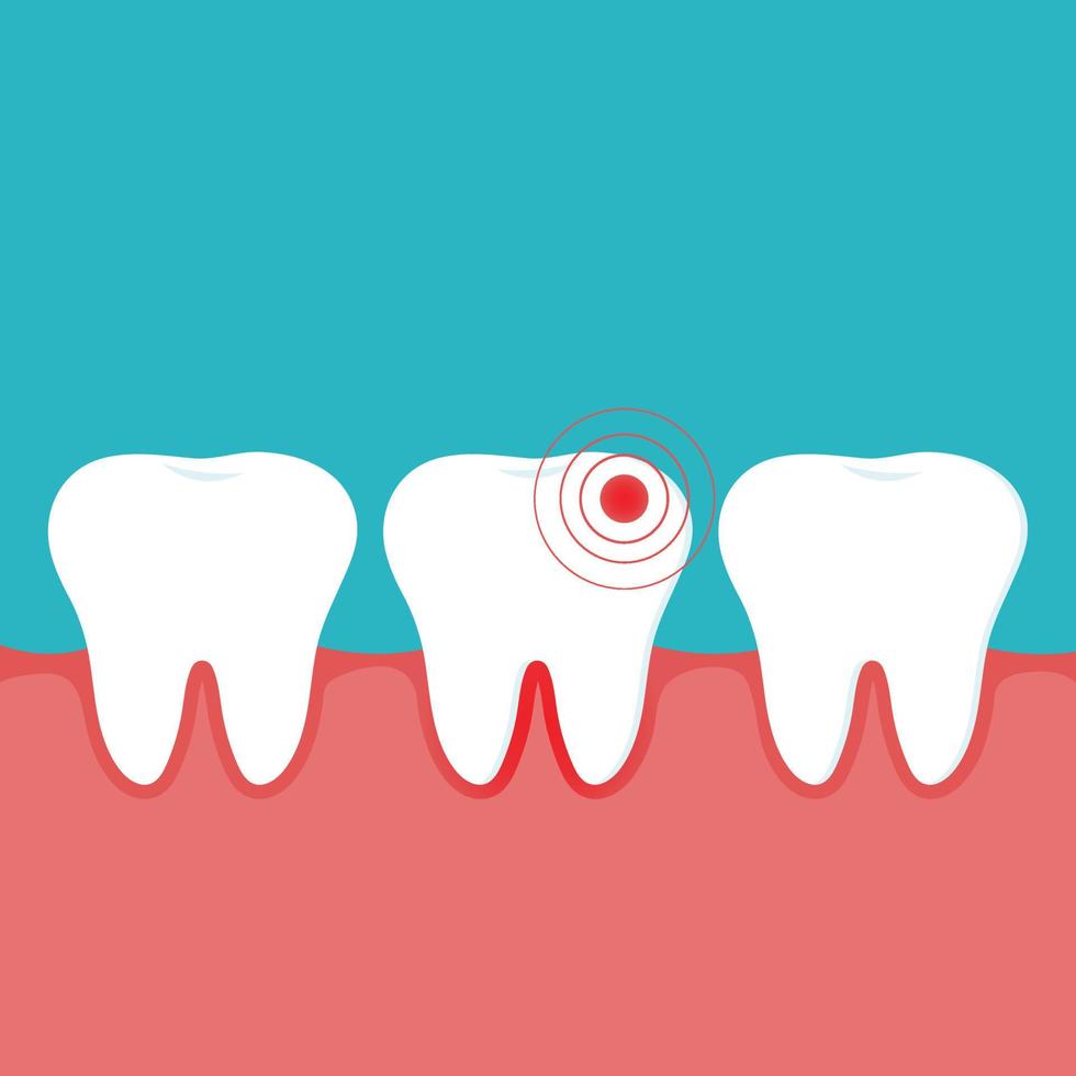 Illustration of an inflamed tooth and gum and healthy teeth. Gingivitis. Concept for dental clinics and oral care brochures. vector