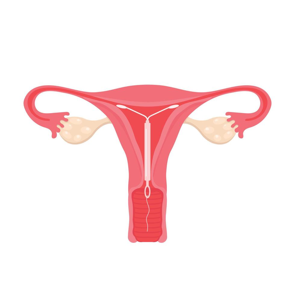 Anatomía del aparato reproductor femenino. anticoncepción femenina. ubicación de la bobina uterina. la salud de la mujer. ilustración vectorial vector