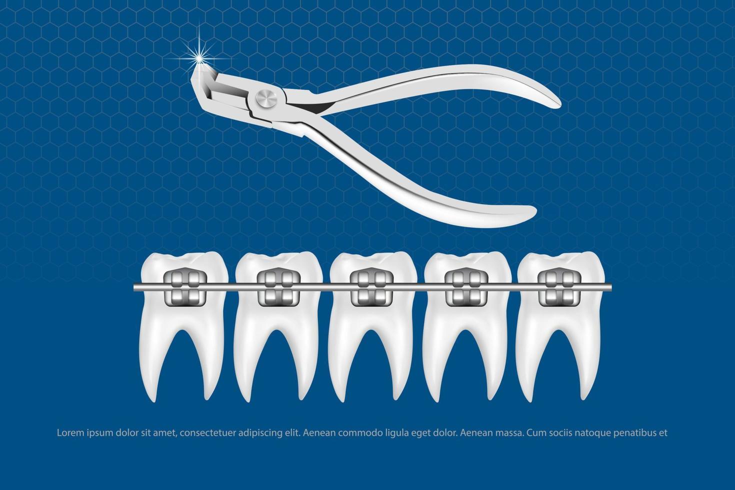 Ilustración vectorial 3d, dientes realistas con frenos en la mandíbula superior e inferior. alineación de la mordida de los dientes, dentición con frenos, frenos dentales. vector