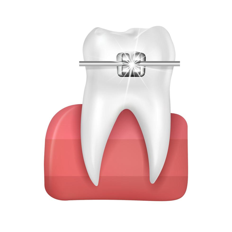 realista 3d vectorortodoncia tratamiento estilo moda hermoso azul. dientes blancos con brackets metálicos. frenos dentales aislados en un fondo blanco. vector