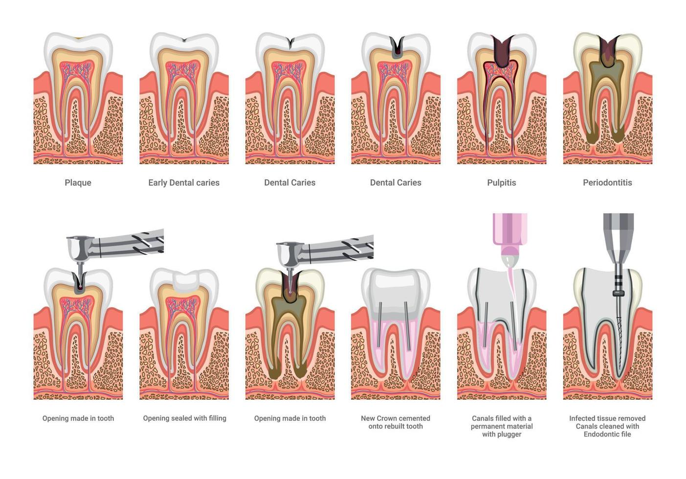 Dental Caries and Treatment Illustrations vector