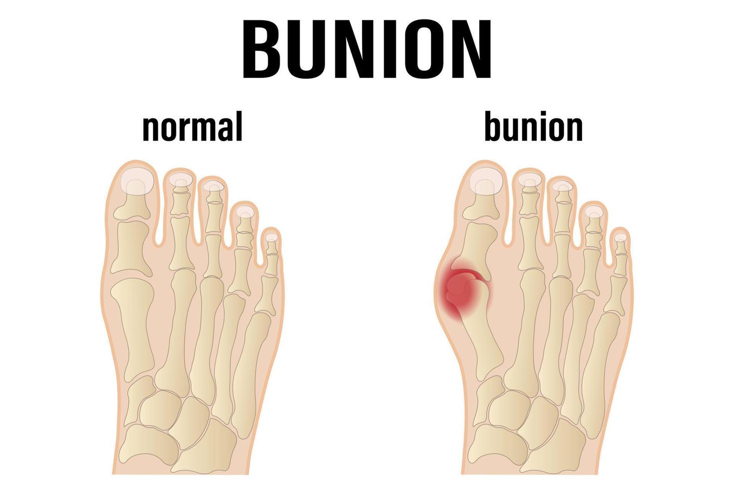 Hallux valgus medical infographic. Vector illustration.