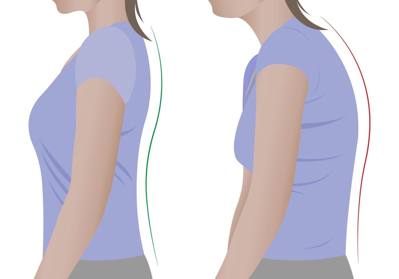 Illustration of a woman's back with a healthy spine and with scoliosis, a bent spine. Vector. vector