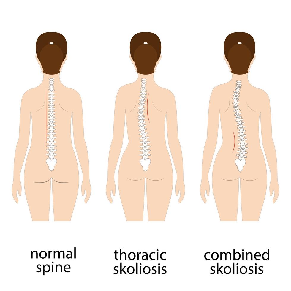 Spine deformation types and healthy spine comparison diagram poster with backbone curvatures. Female profile and back view. Chiropractic information. vector