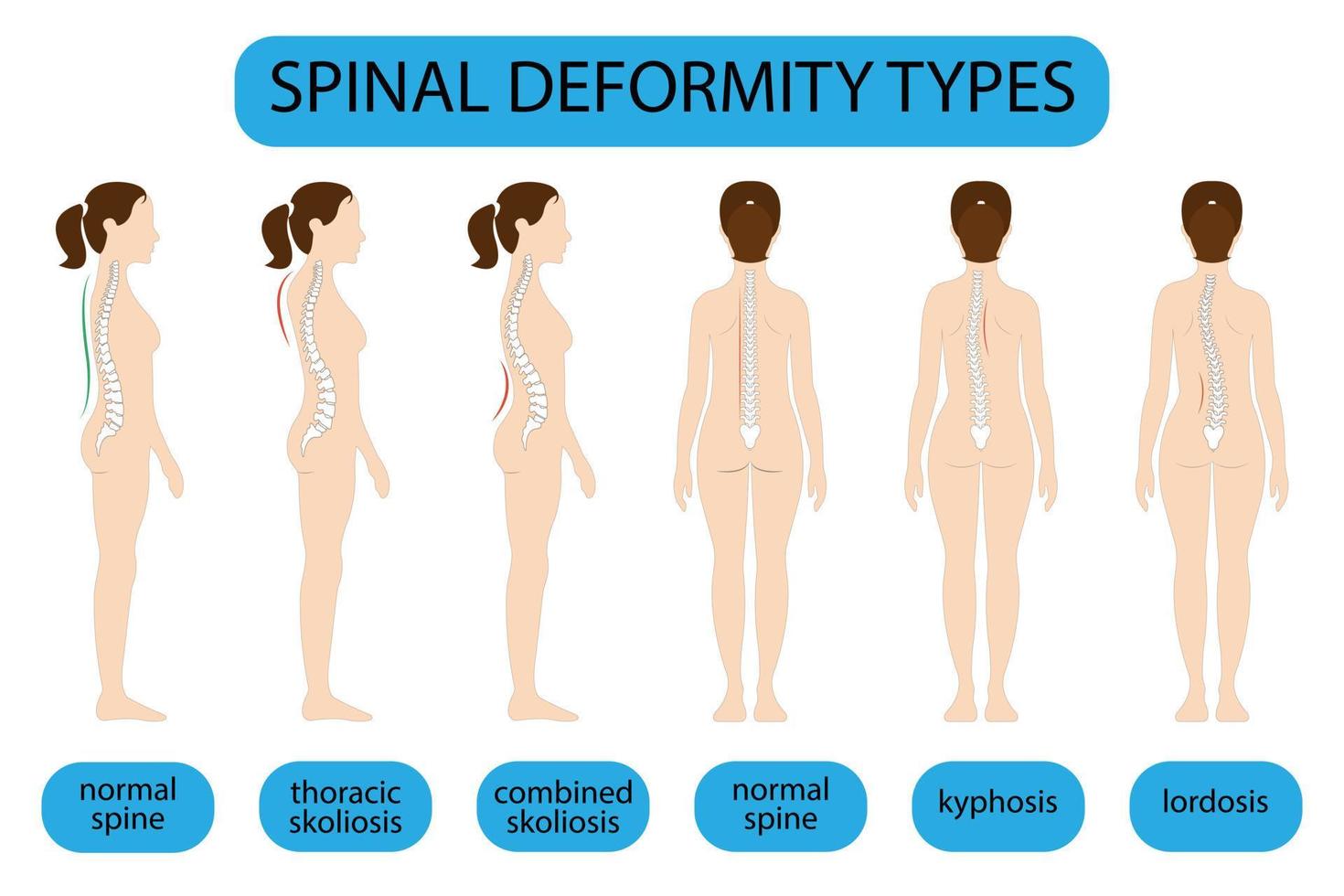 Spine deformation types and healthy spine comparison diagram poster