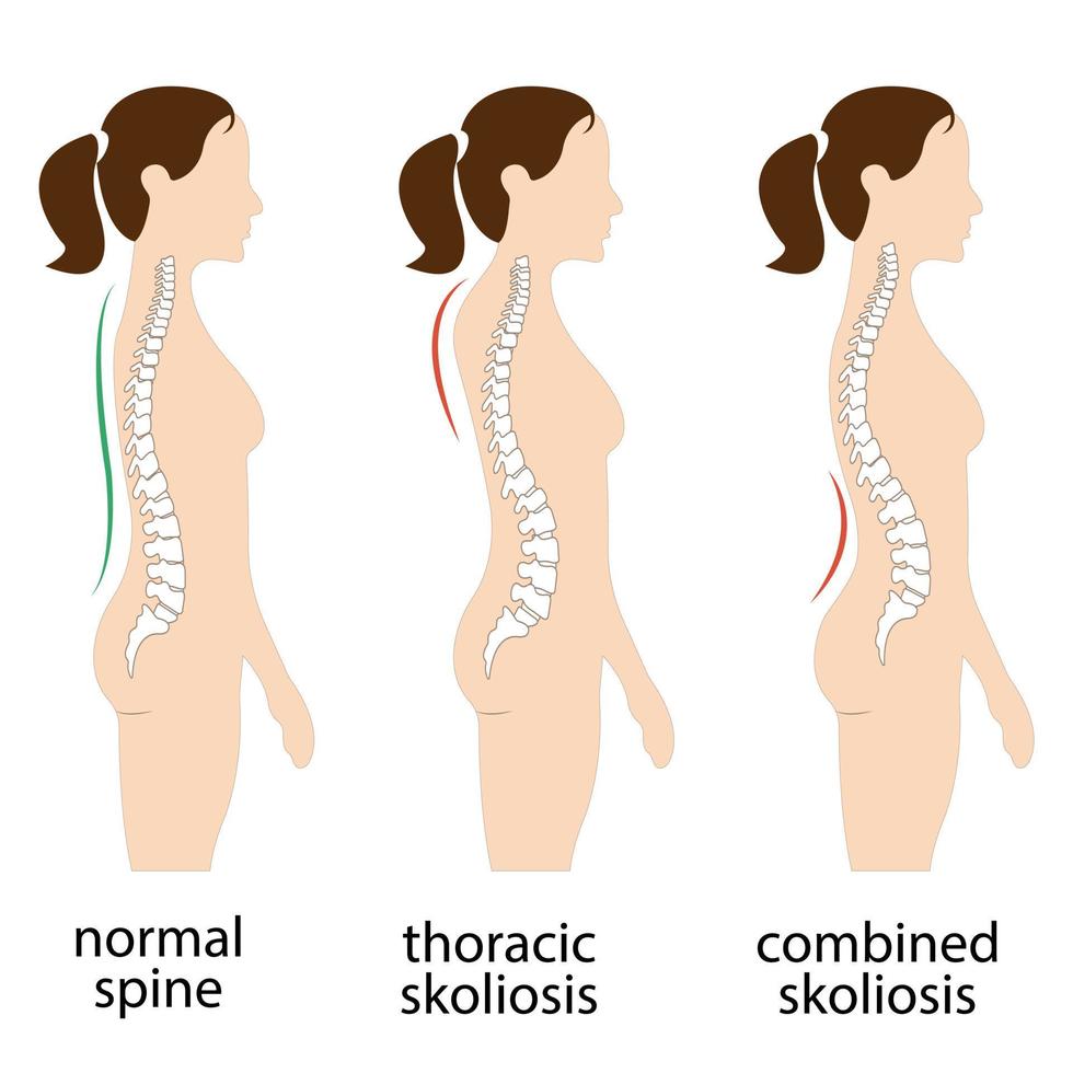 Spine deformation types and healthy spine comparison diagram poster with backbone curvatures. Female profile and back view. Chiropractic information. vector