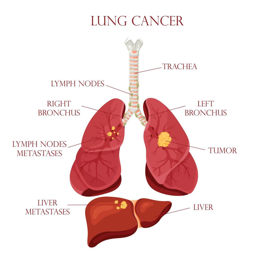 diagrama de enfermedad de cáncer de pulmón. concepto enfermedad órganos internos humanos. ilustración vectorial, estilo de dibujos animados. vector