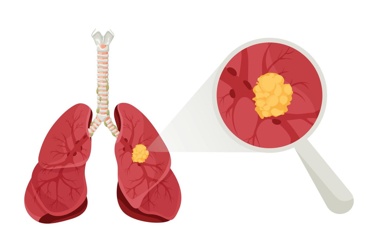 diagrama de enfermedad de cáncer de pulmón. concepto enfermedad órganos internos humanos. ilustración vectorial, estilo de dibujos animados. vector