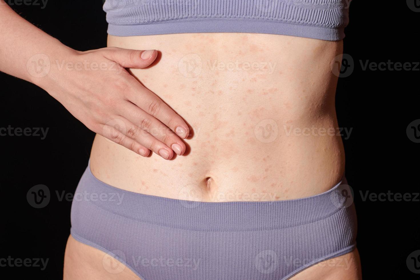 Red allergic rash on belly skin, atopic dermatitis, eczema, inflammation. Woman applying ointment photo