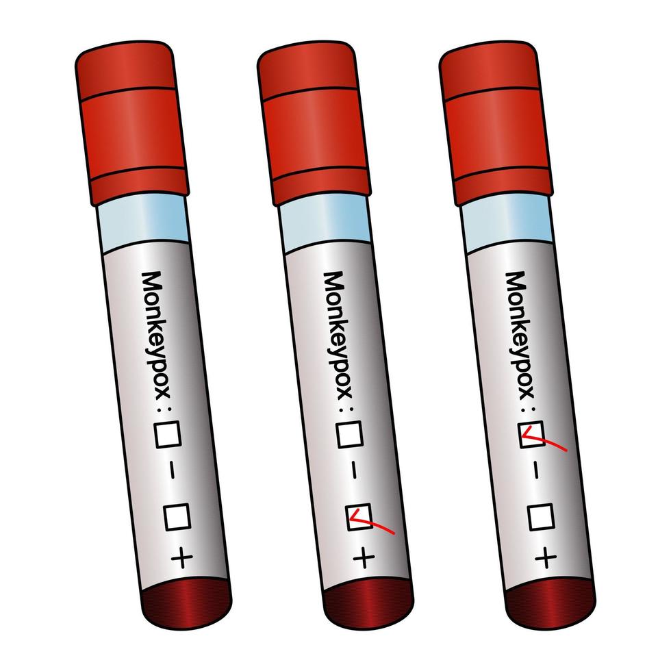 A set of test tubes with the results of laboratory tests of patients' blood for monkeypox virus vector