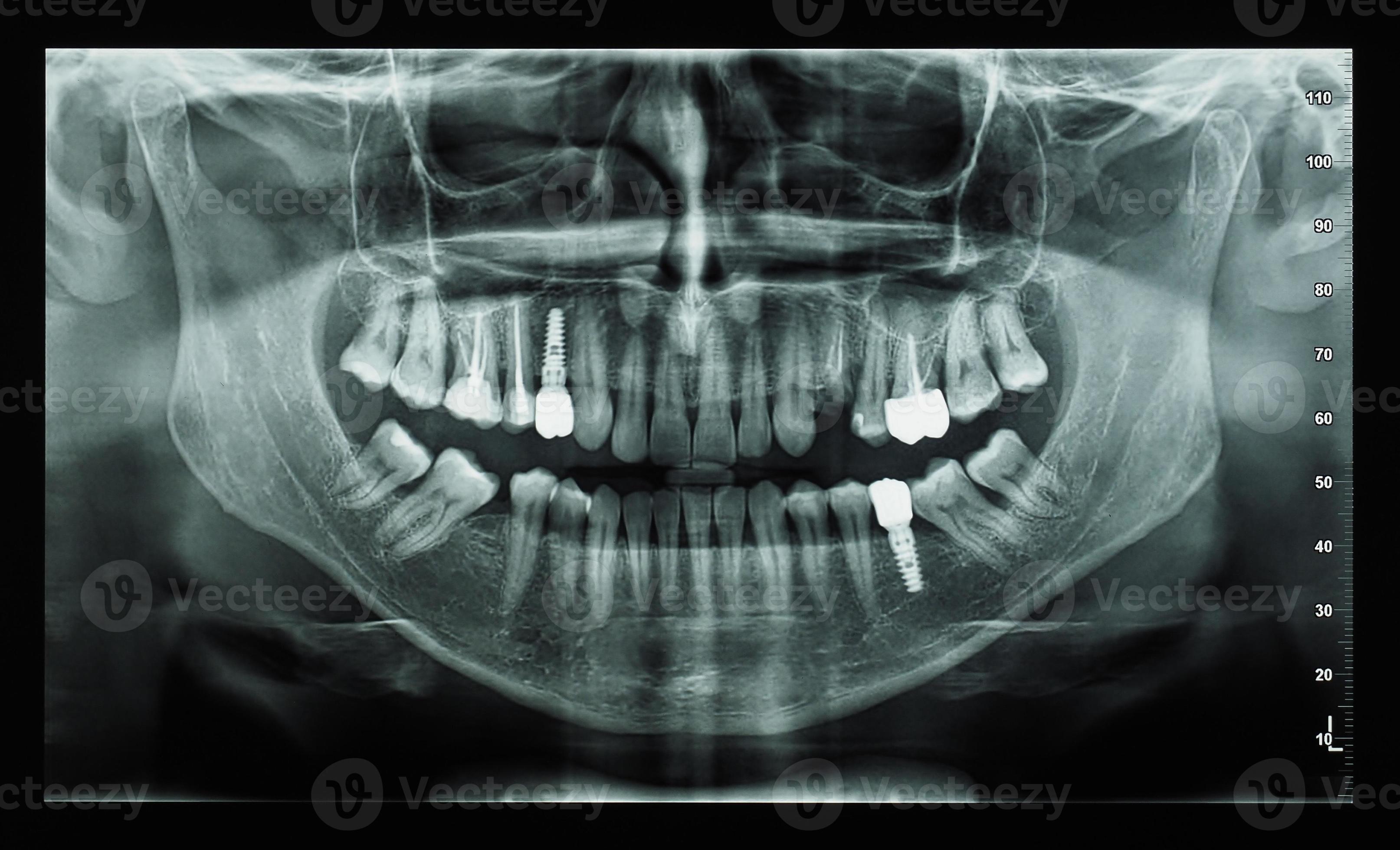 orthopantomograph panoramic image radiograph of teeth 9845733 Stock
