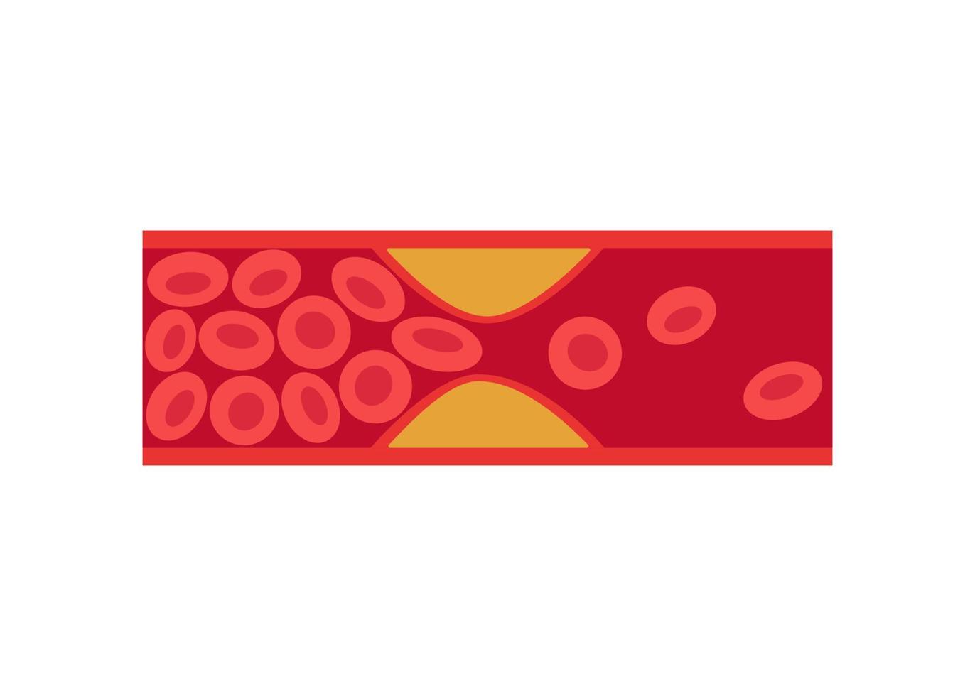 trombosis venosa profunda, enfermedad de las arterias y venas con células grasas, anormalidad del flujo sanguíneo vascular. colesterol en bloqueado en el vaso sanguíneo humano. ilustración vectorial vector