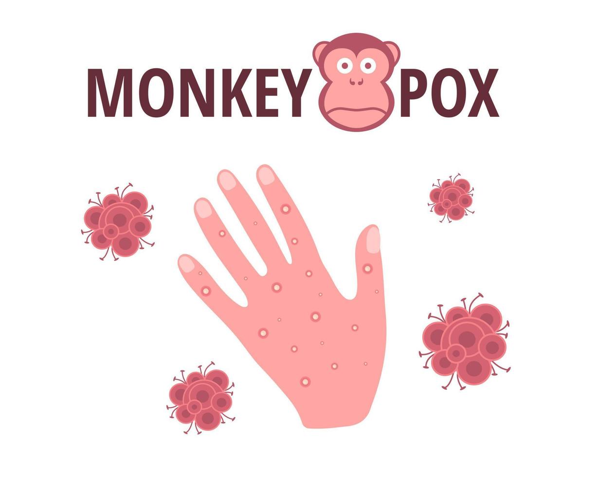 virus de la viruela del mono. diseño vectorial con erupción cutánea en la mano, síntoma de una enfermedad infecciosa vector