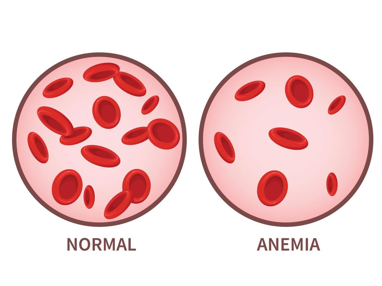 Hemoglobin. Anemia symptoms, blood disease. Health care concept. vector