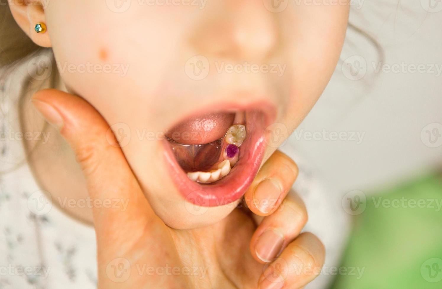 Colored purple filling on the girl's milk chewing tooth. Pediatric dentistry, treatment and examination. A child with an open mouth shows a tooth in close-up on a white background. photo