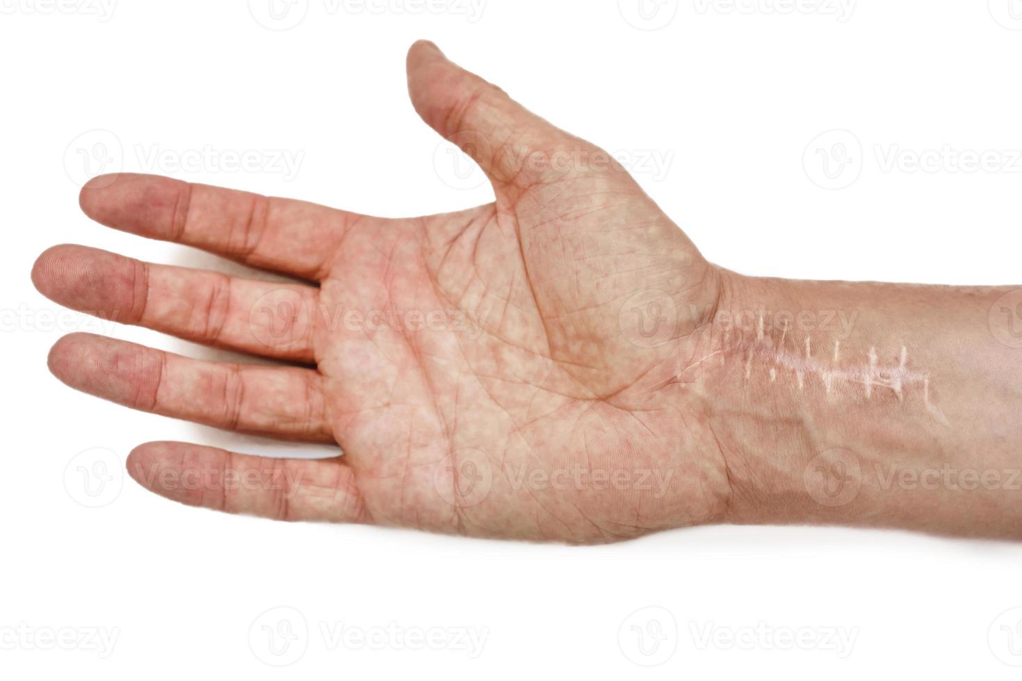 Scar with stitches on the wrist after surgery. Fracture of the bones of the hands isolated on white background photo