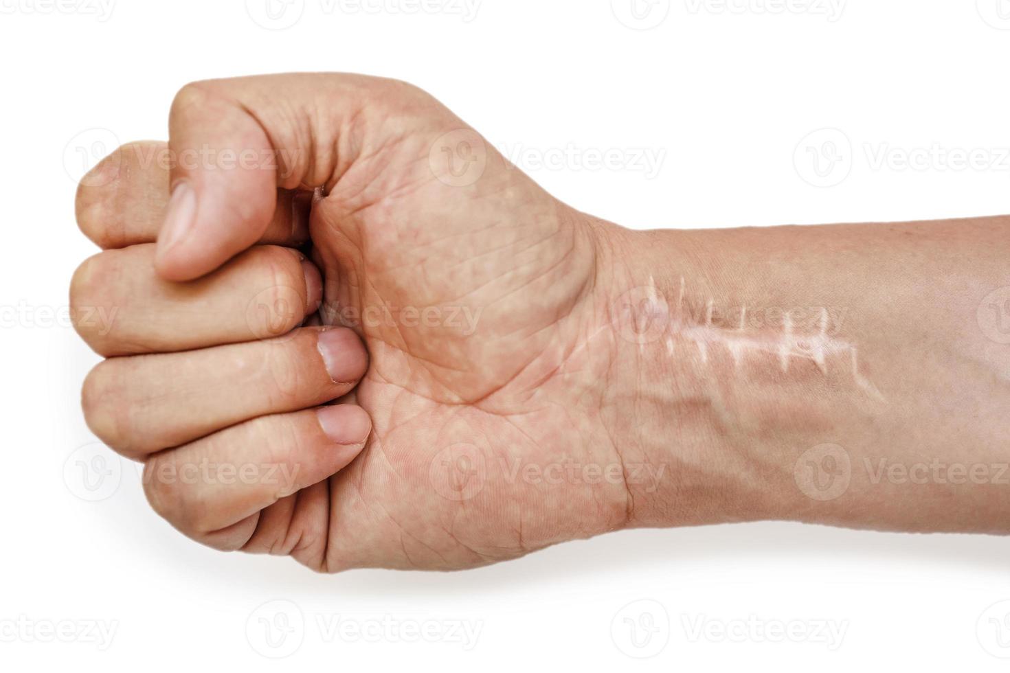 Scar with stitches on the wrist after surgery. Fracture of the bones of the hands in fist isolated on white background photo
