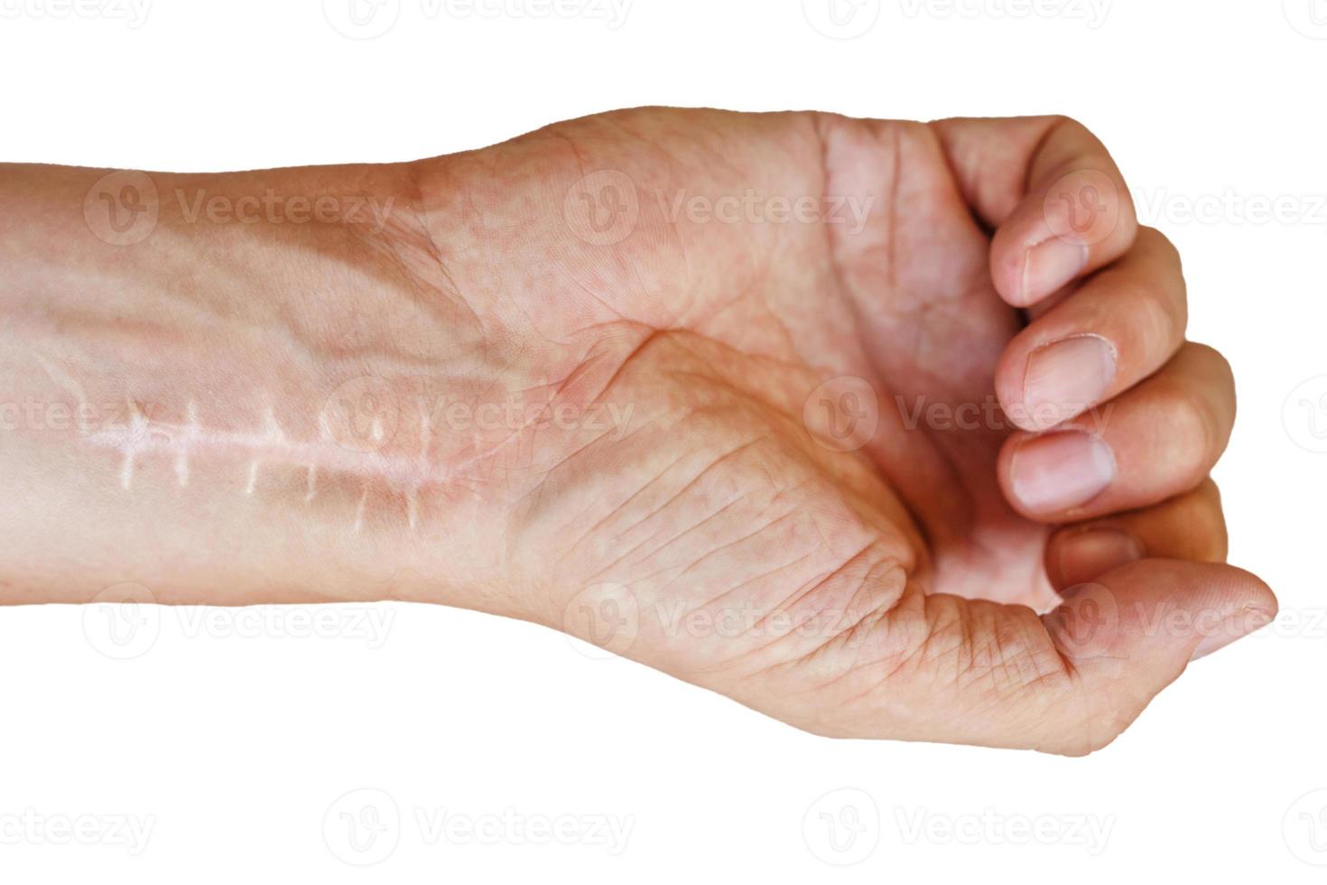 Scar with stitches on the wrist after surgery. Fracture of the bones of the hands in fist isolated on white background photo