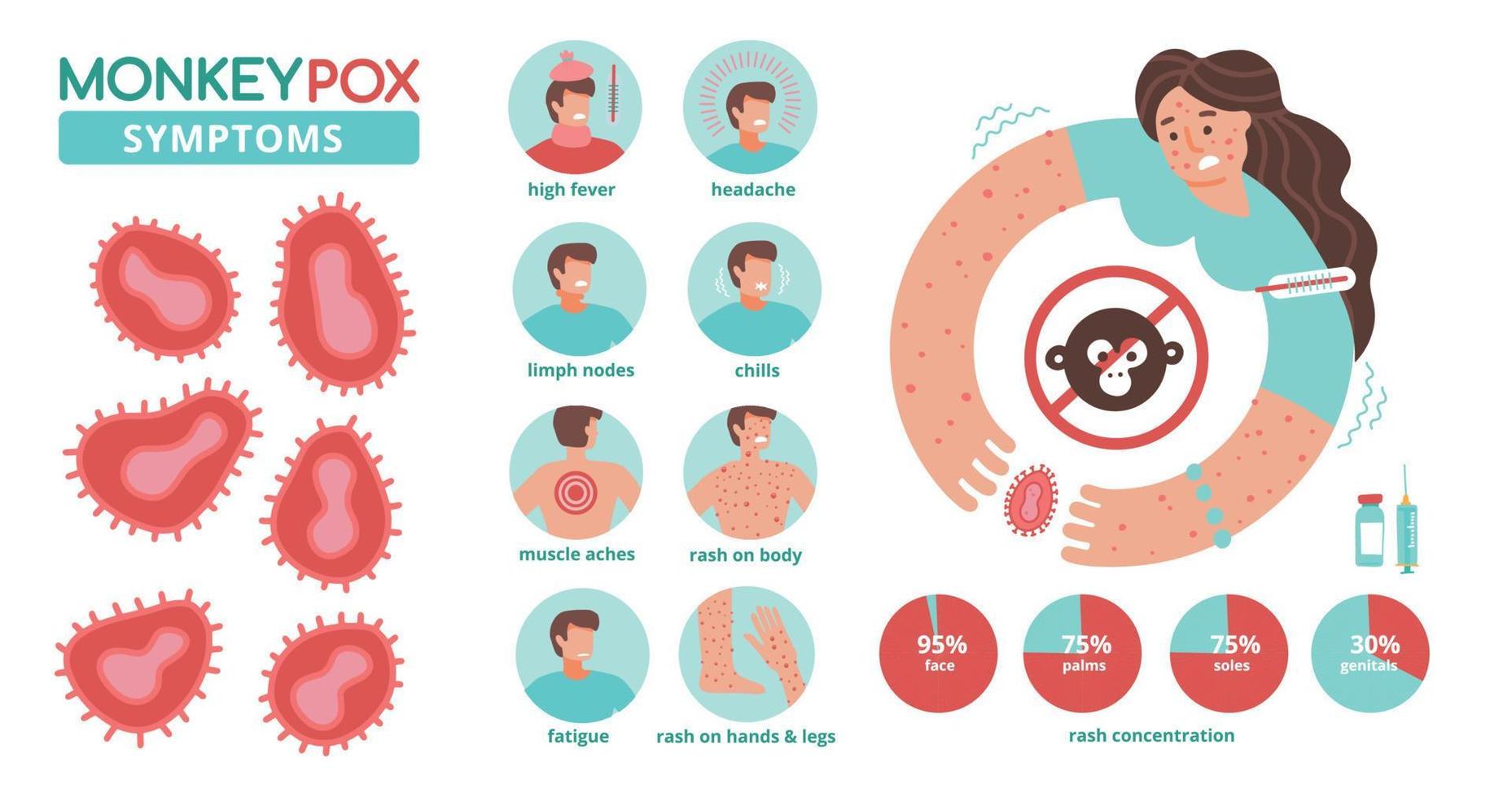 Monkeypox virus symptoms infographics. New orthopox virus outbreak worldwide spreading. Detailed info for people awareness in human diseases infection. Medical concept. Flat vector illustration.